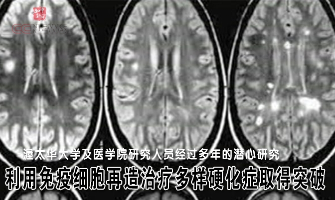 利用免疫细胞再造治疗多样硬化症取得突破